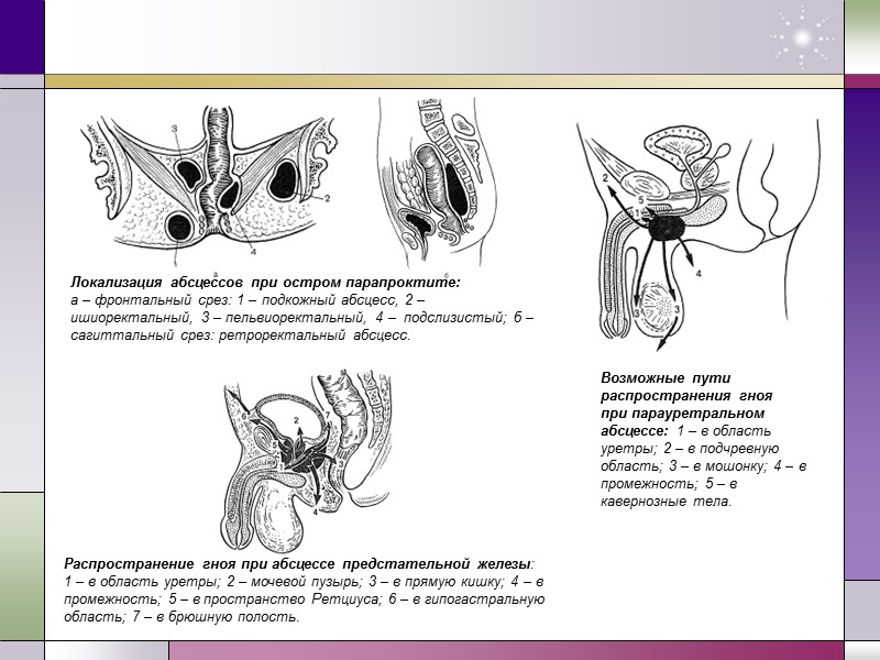 Локализация абсцессов при остром парапроктите:  а – фронтальный срез: 1 – подкожный абсцесс,